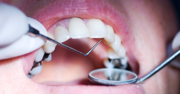 Tratamento Cárie - Dentista Porto Alegre, Clinica Odontológica Porto Alegre