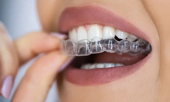 Invisalign - Dentista Porto Alegre, Clinica Odontológica Porto Alegre