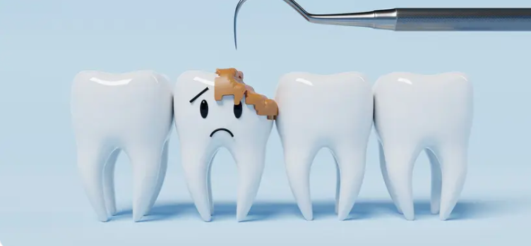 Tratamento Carie - Dentista Porto Alegre, Clinica Odontológica Porto Alegre